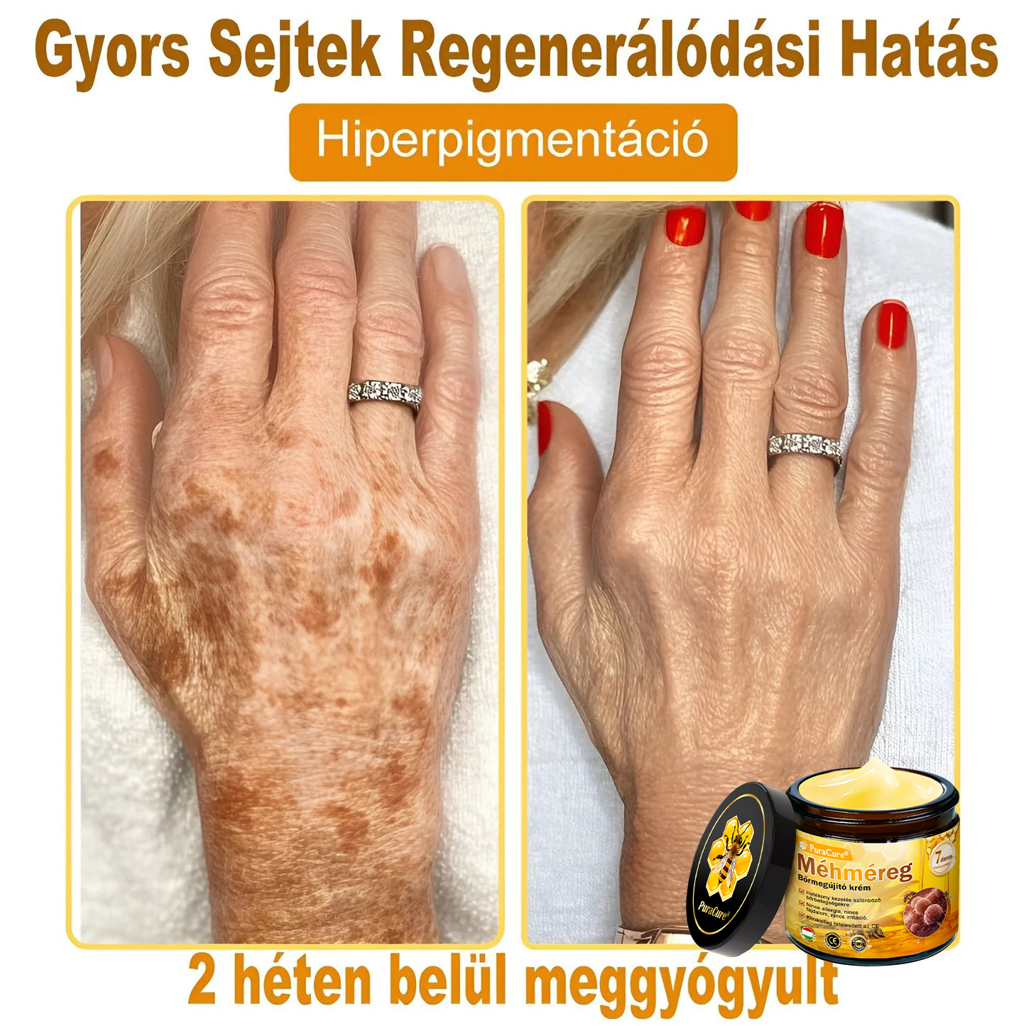 𝐏𝐮𝐫𝐚𝐂𝐮𝐫𝐞® 𝐌é𝐡𝐦é𝐫𝐞𝐠 𝐁ő𝐫 𝐇𝐞𝐥𝐲𝐫𝐞á𝐥𝐥í𝐭ó 𝐊𝐫é𝐦 (👨‍⚕‍𝐂𝐄 𝐓𝐚𝐧ú𝐬í𝐭𝐯á𝐧𝐲)👍✅