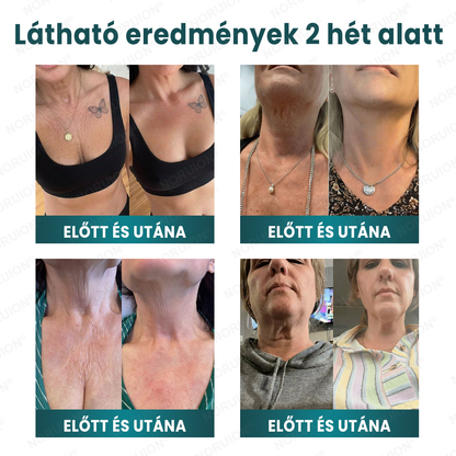 ✨ NORUION® Q10 x Növényi Nano Exoszóma Haladó Ránctalanító Krém
