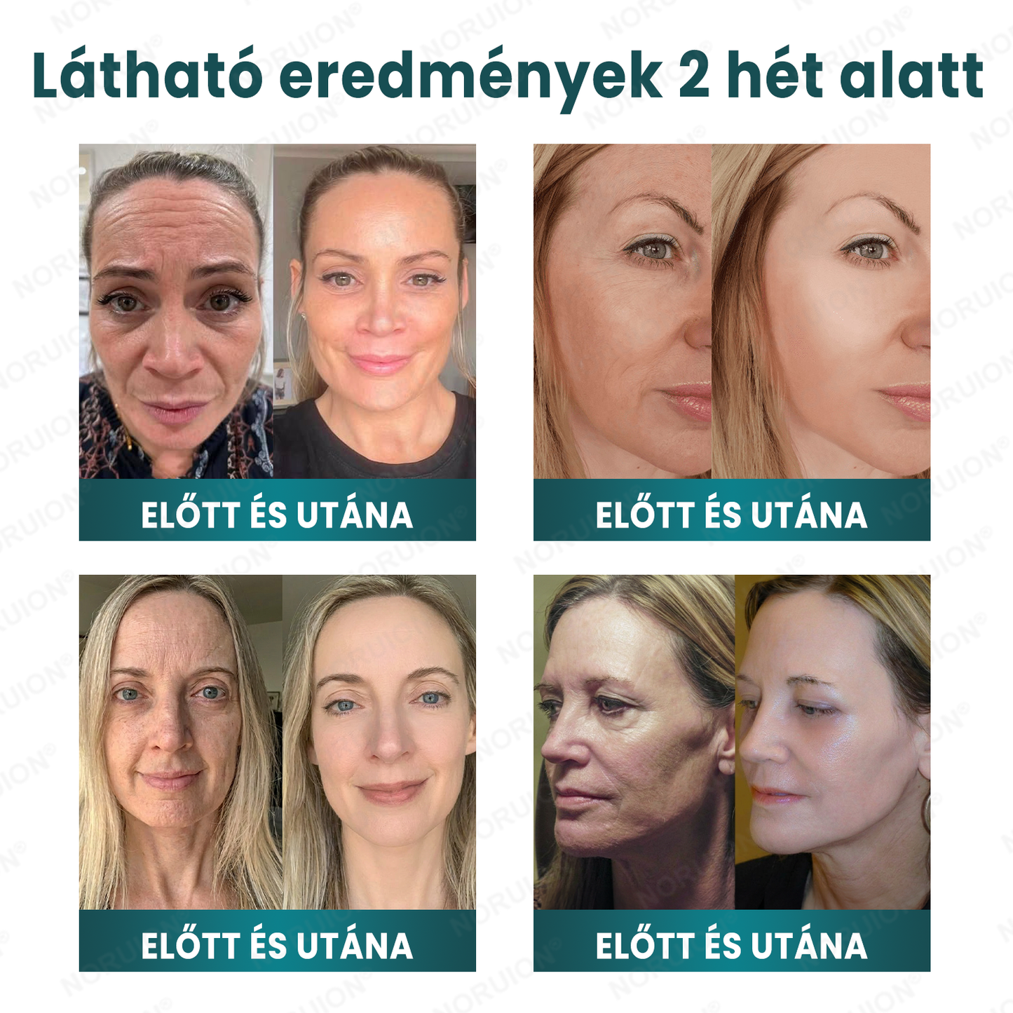 ✨ NORUION® Q10 x Növényi Nano Exoszóma Haladó Ránctalanító Krém
