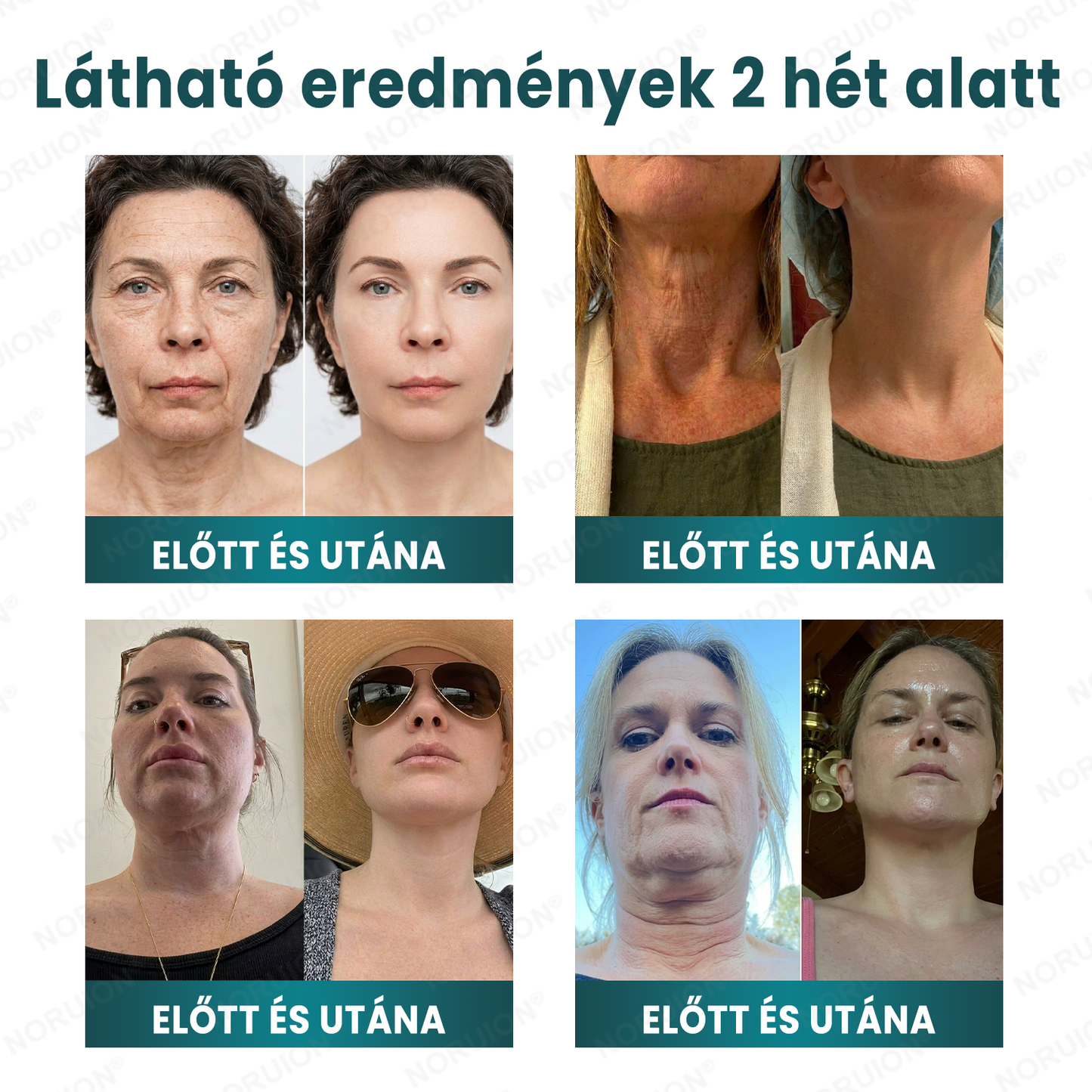 ✨ NORUION® Q10 x Növényi Nano Exoszóma Haladó Ránctalanító Krém