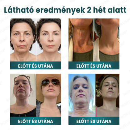 ✨ NORUION® Q10 x Növényi Nano Exoszóma Haladó Ránctalanító Krém