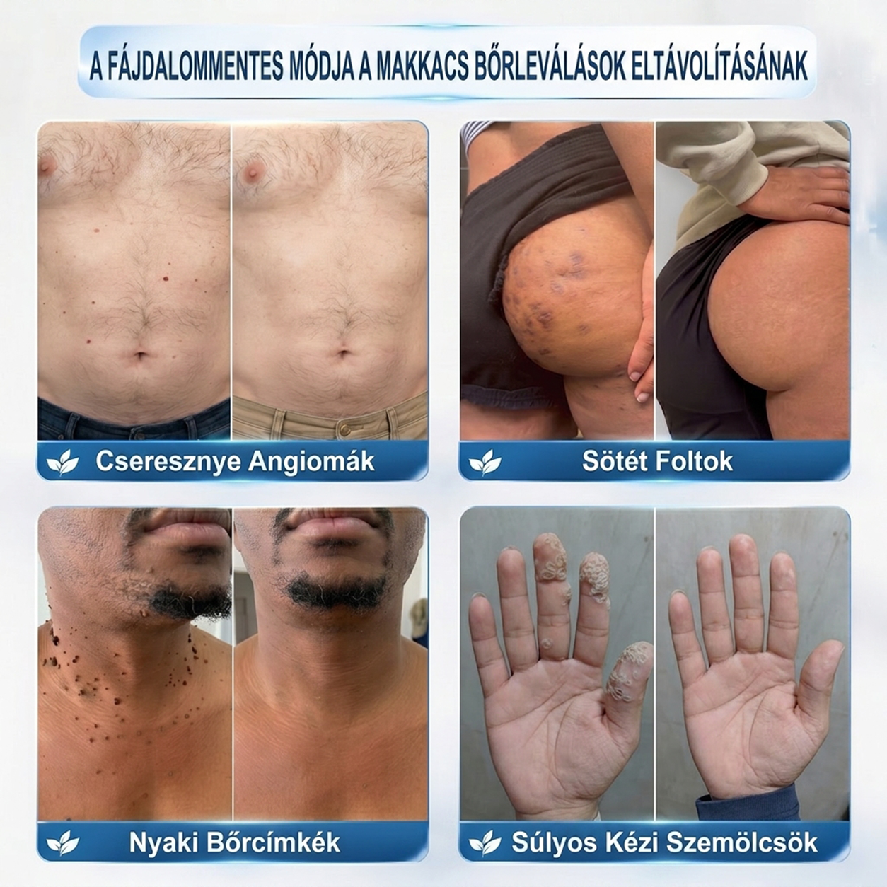PuraCure® 𝟕 𝐍𝐚𝐩𝐨𝐬 Bőrkinövés- és Folteltávolító Toll Fájdalommentes és Hegmentes Professzionális Rollerball