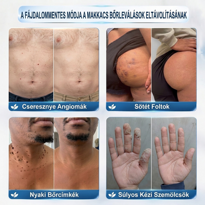 PuraCure® 𝟕 𝐍𝐚𝐩𝐨𝐬 Bőrkinövés- és Folteltávolító Toll Fájdalommentes és Hegmentes Professzionális Rollerball