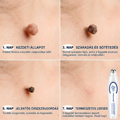 PuraCure® 𝟕 𝐍𝐚𝐩𝐨𝐬 Bőrkinövés- és Folteltávolító Toll Fájdalommentes és Hegmentes Professzionális Rollerball