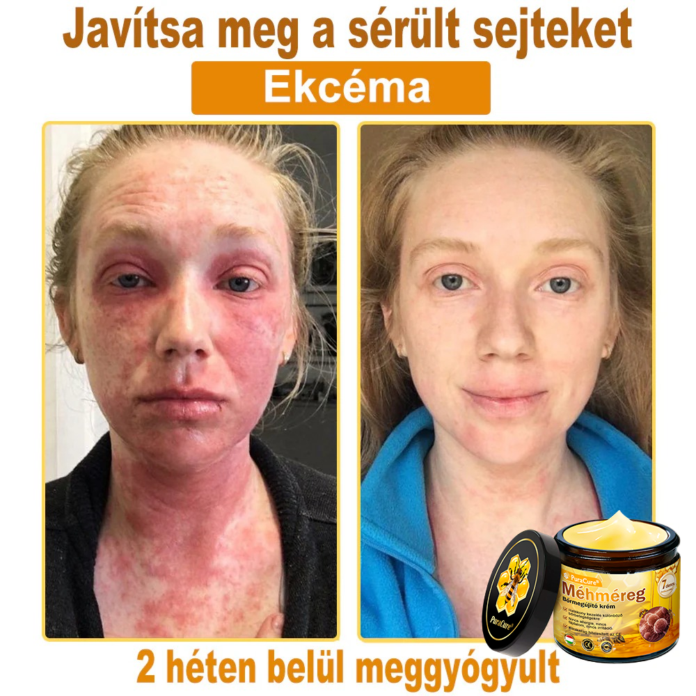 𝐏𝐮𝐫𝐚𝐂𝐮𝐫𝐞® 𝐌é𝐡𝐦é𝐫𝐞𝐠 𝐁ő𝐫 𝐇𝐞𝐥𝐲𝐫𝐞á𝐥𝐥í𝐭ó 𝐊𝐫é𝐦 (👨‍⚕‍𝐂𝐄 𝐓𝐚𝐧ú𝐬í𝐭𝐯á𝐧𝐲)👍✅