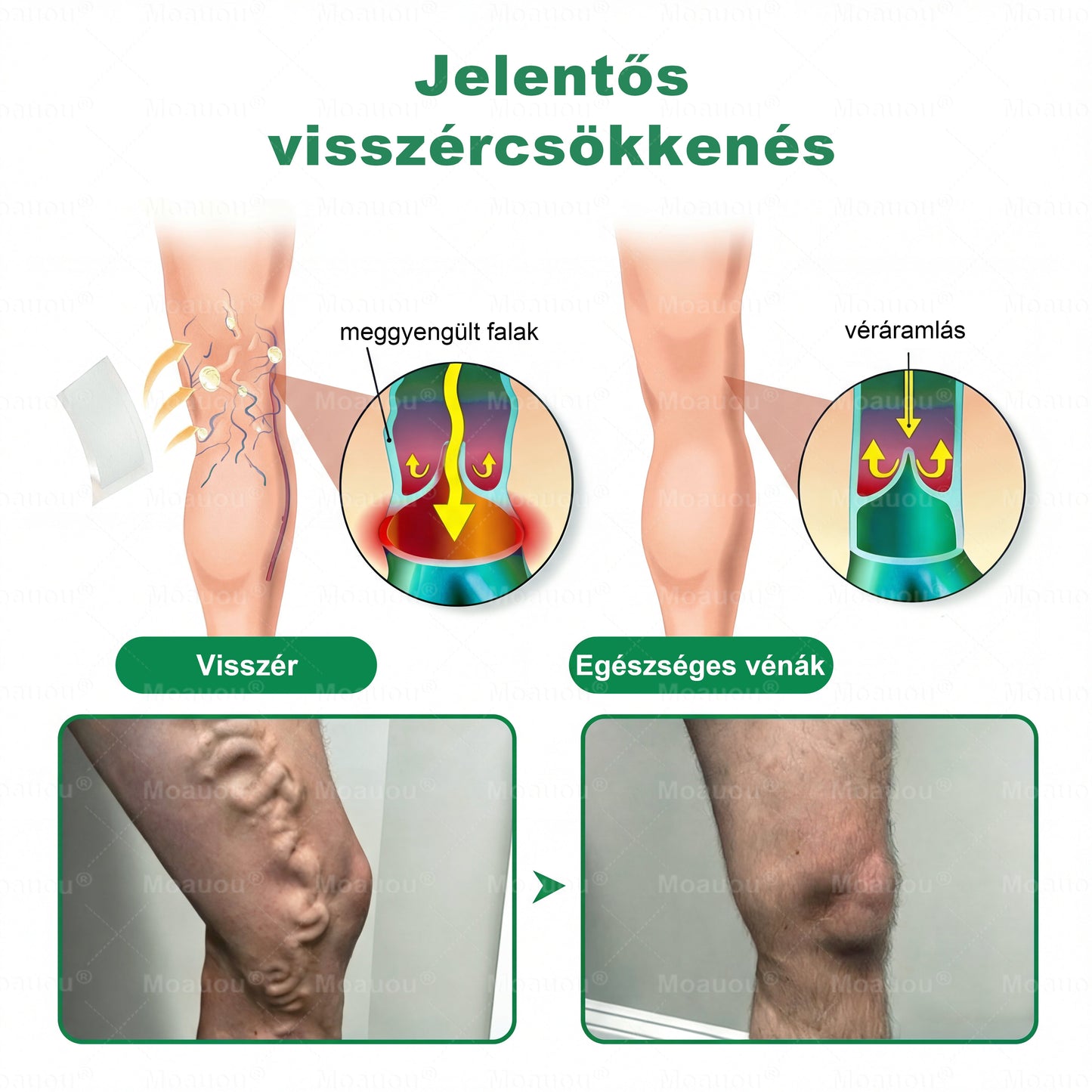 🇭🇺👨‍⚕️✅Moauou® Ércélzó Mikrotűs Tapasz ⚡ Azonnali enyhülés, hosszan tartó eredmények – NAGY AKCIÓ!
